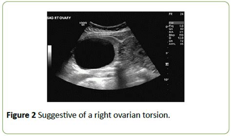 ovarian torsion cause positive pregnancy test|ovarian torsion in premenopausal patients.